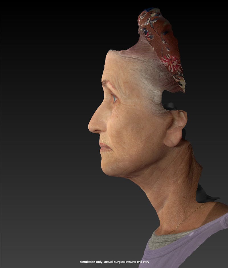 Facelift Before & After Gallery - Patient 148991086 - Image 10