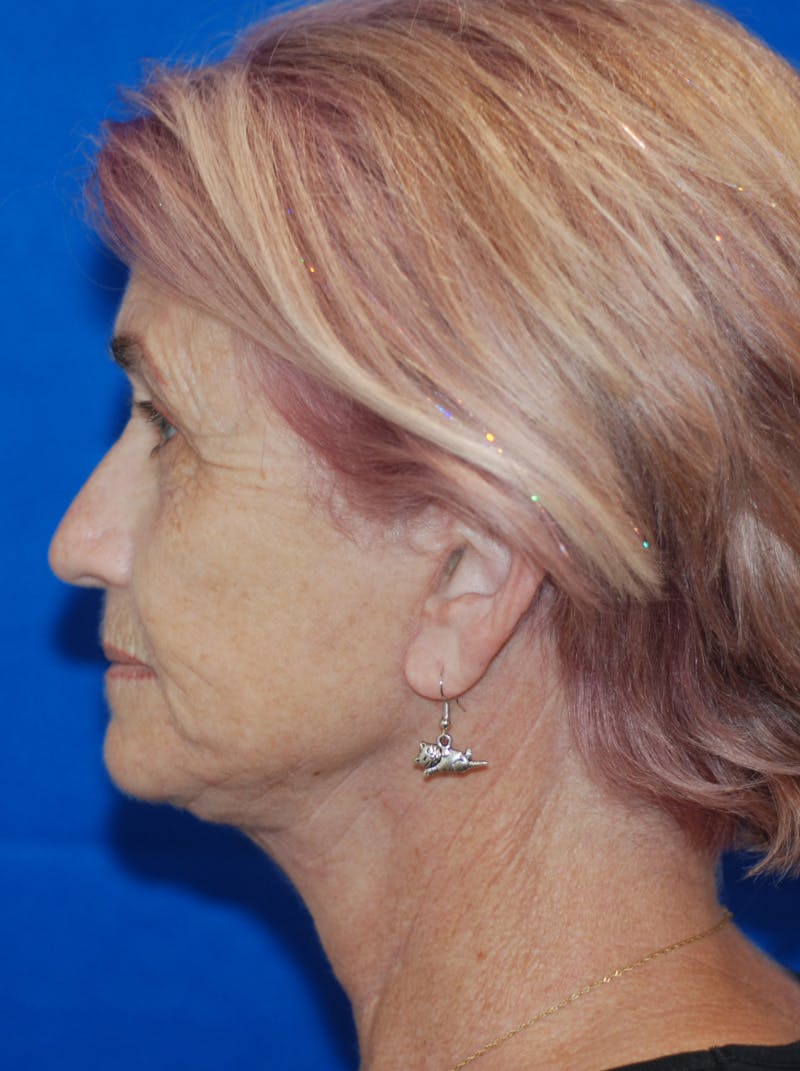Facelift Before & After Gallery - Patient 148991086 - Image 4