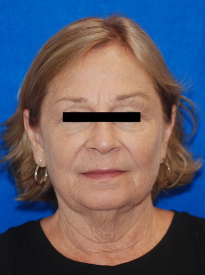 Facelift Before & After Gallery - Patient 148991101 - Image 1