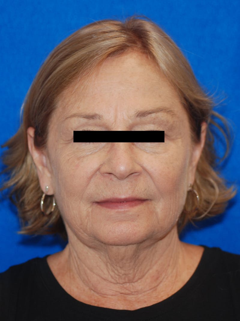 Facelift Before & After Gallery - Patient 148991101 - Image 3