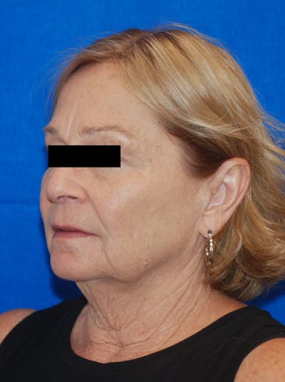 Facelift Before & After Gallery - Patient 148991101 - Image 1