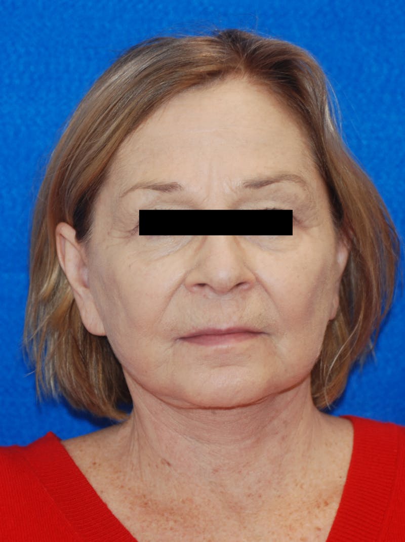 Facelift Before & After Gallery - Patient 148991101 - Image 4