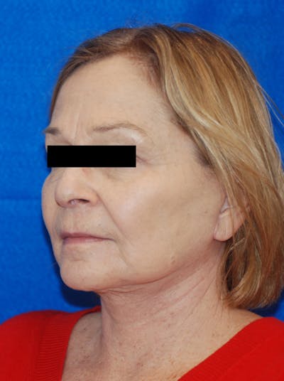 Facelift Before & After Gallery - Patient 148991101 - Image 2