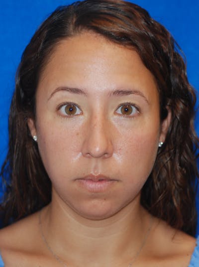 Chin Implant Before & After Gallery - Patient 148991106 - Image 1