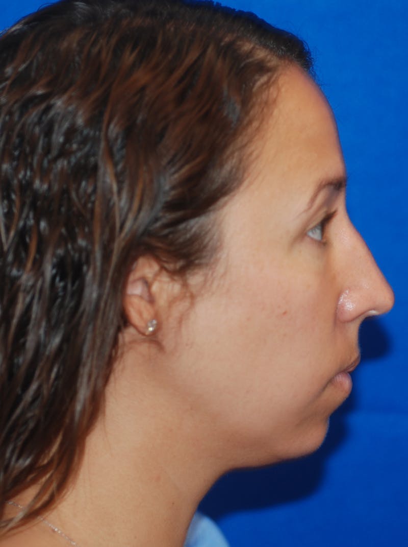 Chin Implant Before & After Gallery - Patient 148991106 - Image 3