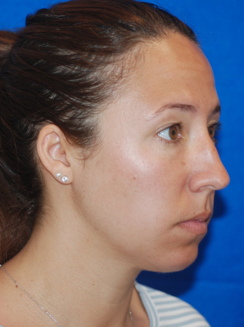 Chin Implant Before & After Gallery - Patient 148991106 - Image 6