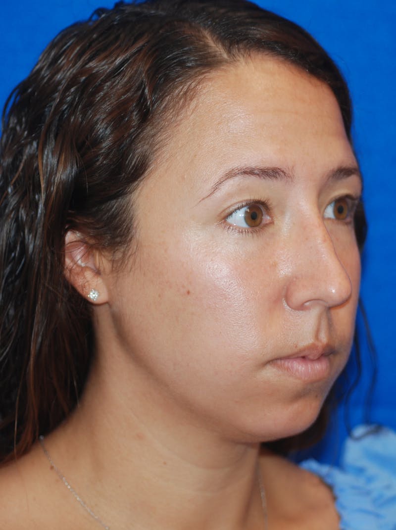 Chin Implant Before & After Gallery - Patient 148991106 - Image 5