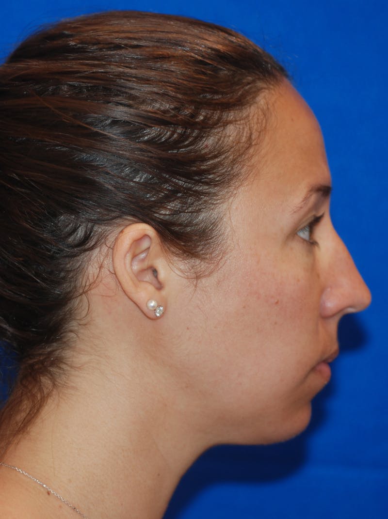 Chin Implant Before & After Gallery - Patient 148991106 - Image 4