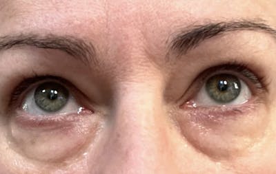 Eyelid Surgery Before & After Gallery - Patient 148991110 - Image 1