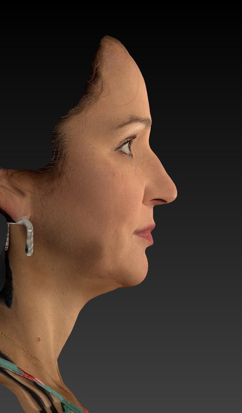 Facelift Before & After Gallery - Patient 148991129 - Image 5