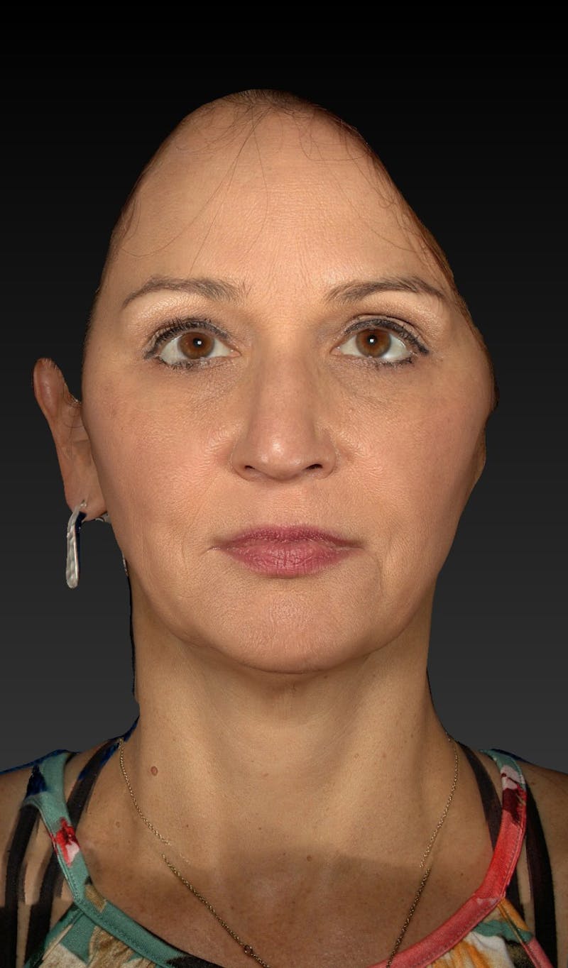 Facelift Before & After Gallery - Patient 148991129 - Image 9