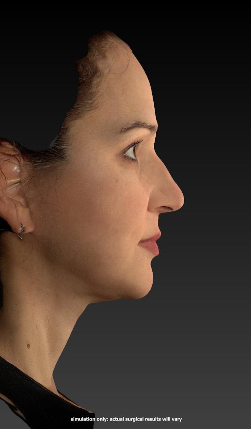 Facelift Before & After Gallery - Patient 148991129 - Image 6