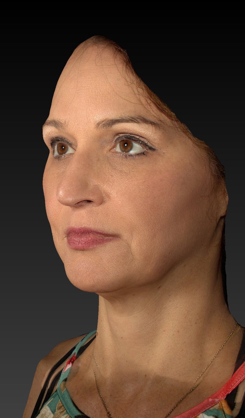 Facelift Before & After Gallery - Patient 148991129 - Image 3