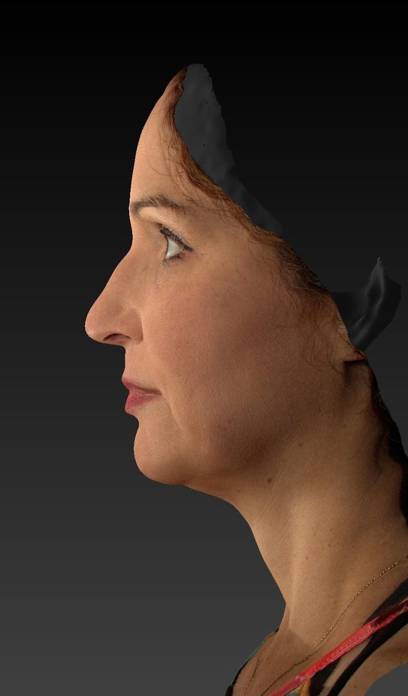 Facelift Before & After Gallery - Patient 148991129 - Image 7