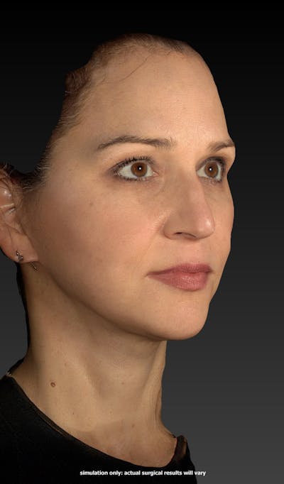 Facelift Before & After Gallery - Patient 148991129 - Image 2