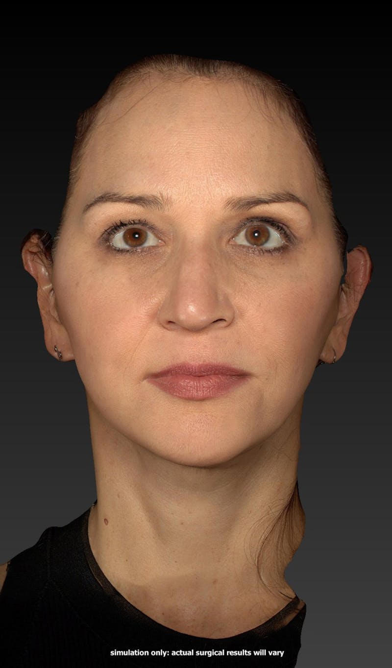 Facelift Before & After Gallery - Patient 148991129 - Image 10