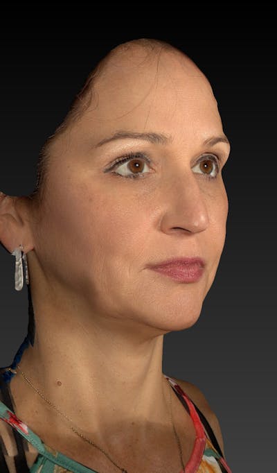 Facelift Before & After Gallery - Patient 148991129 - Image 1
