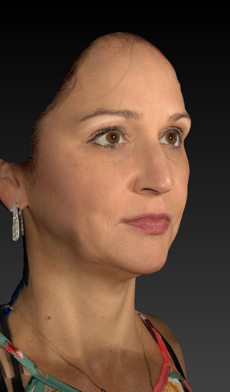 Facelift Before & After Gallery - Patient 148991129 - Image 9