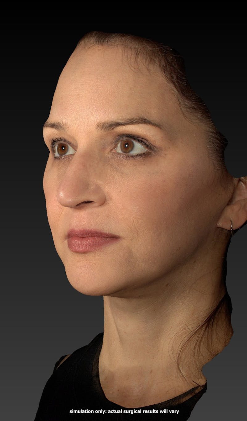 Facelift Before & After Gallery - Patient 148991129 - Image 4