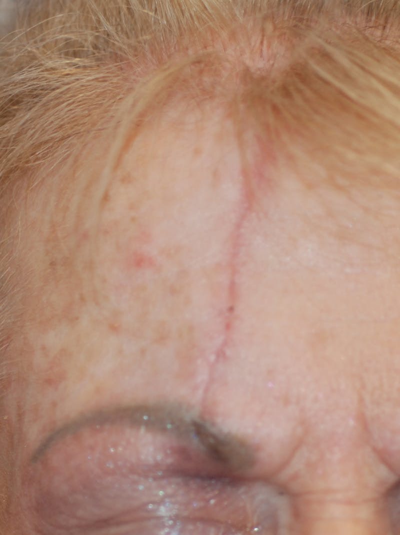 Microneedling with Exosomes Before & After Gallery - Patient 148991135 - Image 1