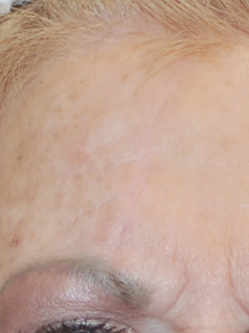 Microneedling with Exosomes Before & After Gallery - Patient 148991135 - Image 2