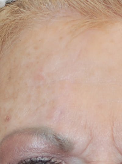 Microneedling with Exosomes Before & After Gallery - Patient 148991135 - Image 2