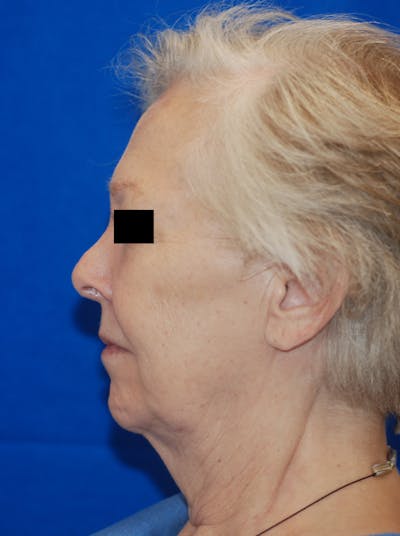 Facelift Before & After Gallery - Patient 148991140 - Image 1