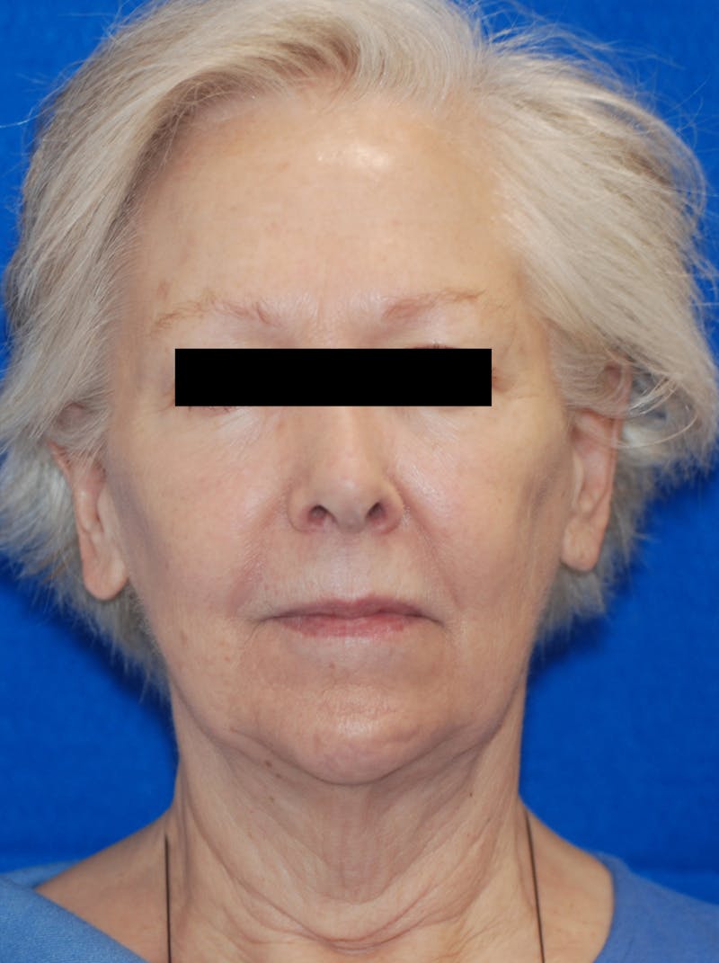 Facelift Before & After Gallery - Patient 148991140 - Image 3