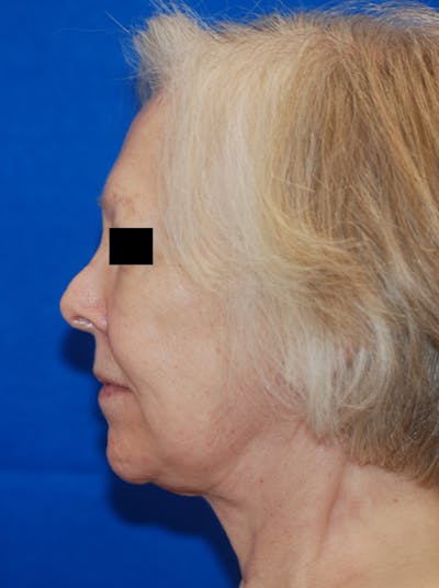 Facelift Before & After Gallery - Patient 148991140 - Image 2