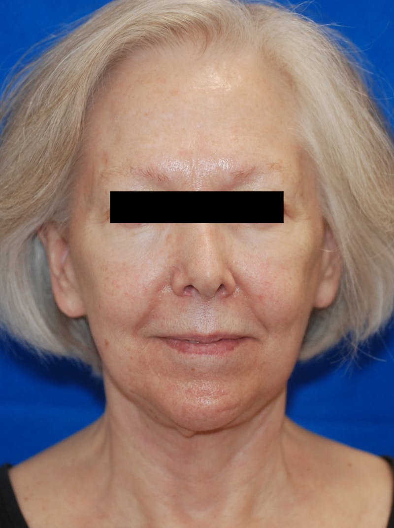 Facelift Before & After Gallery - Patient 148991140 - Image 4