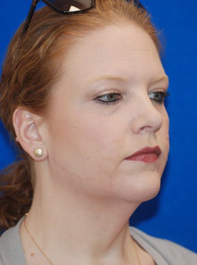 Facelift Before & After Gallery - Patient 148991139 - Image 1