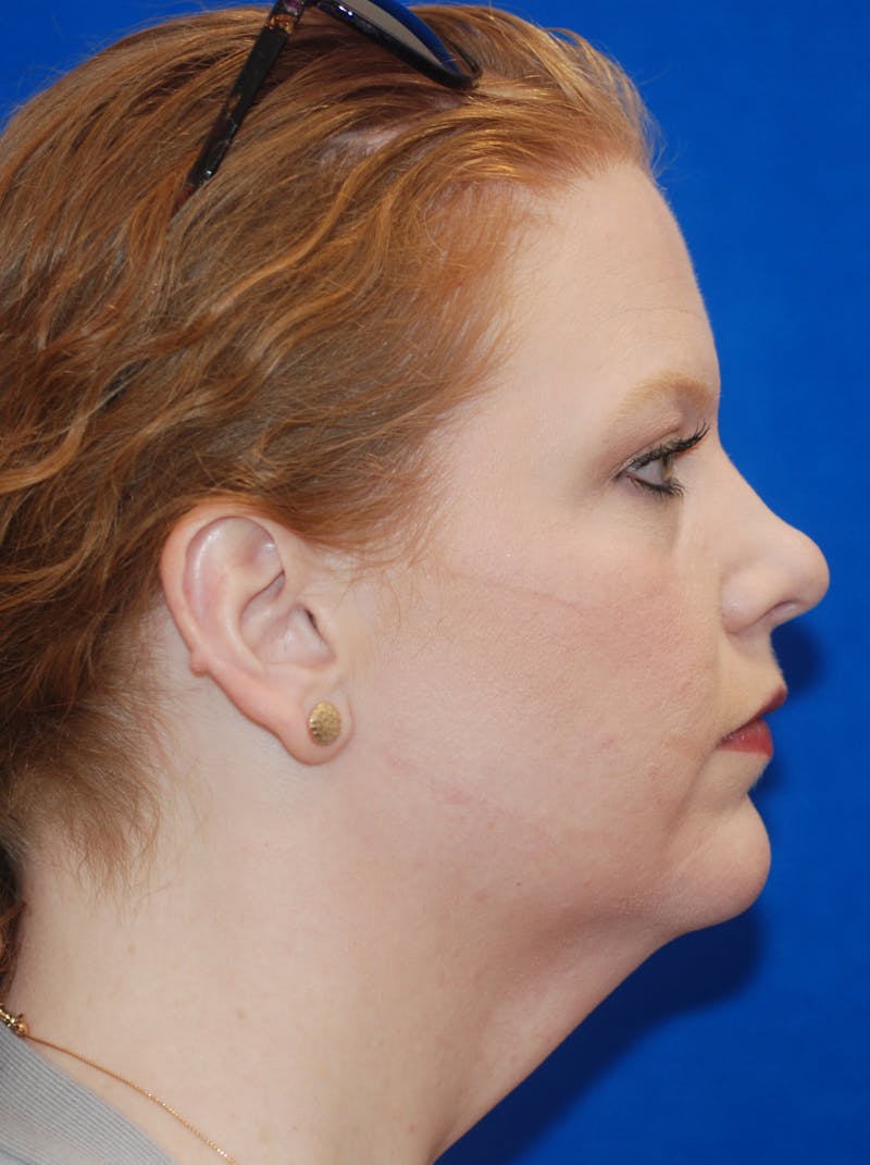Facelift Before & After Gallery - Patient 148991139 - Image 3
