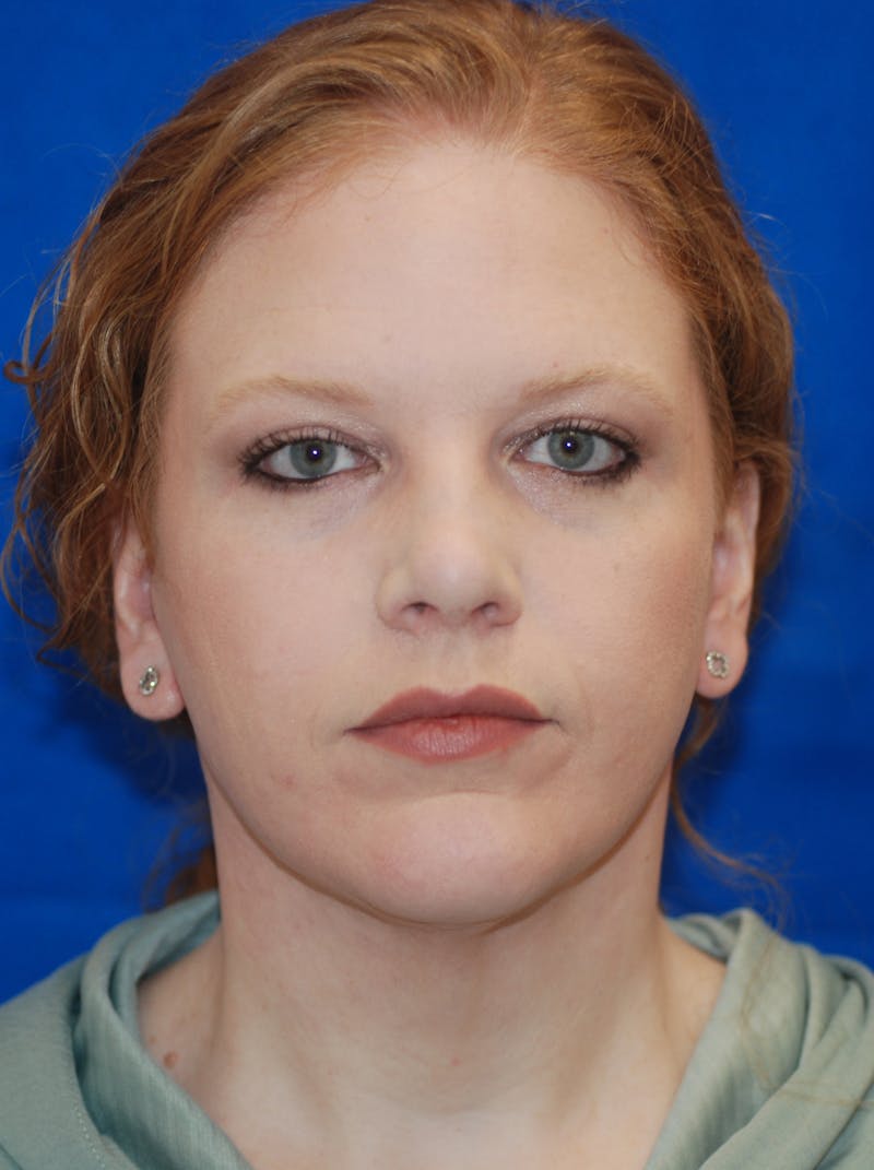 Facelift Before & After Gallery - Patient 148991139 - Image 6