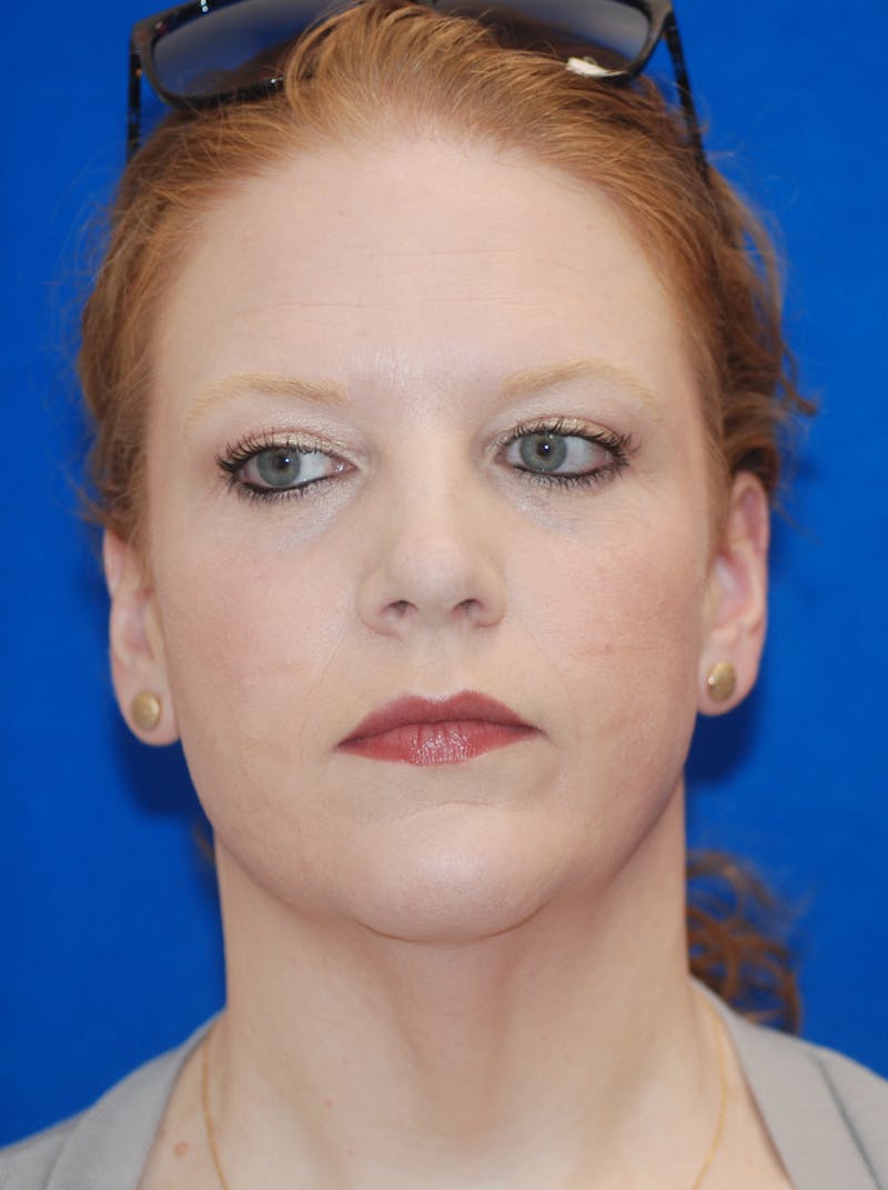 Facelift Before & After Gallery - Patient 148991139 - Image 5
