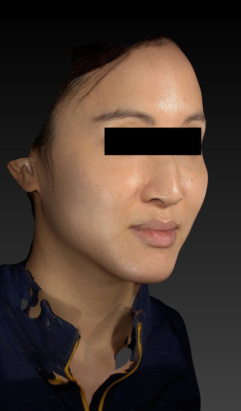 Dermal Fillers Before & After Gallery - Patient 148991158 - Image 1