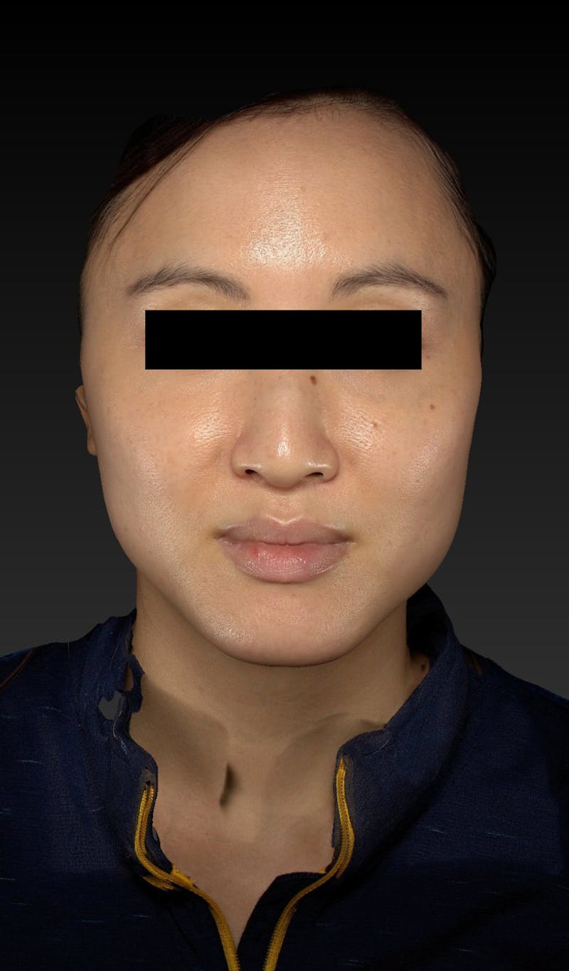 Botox Before & After Gallery - Patient 148991154 - Image 3