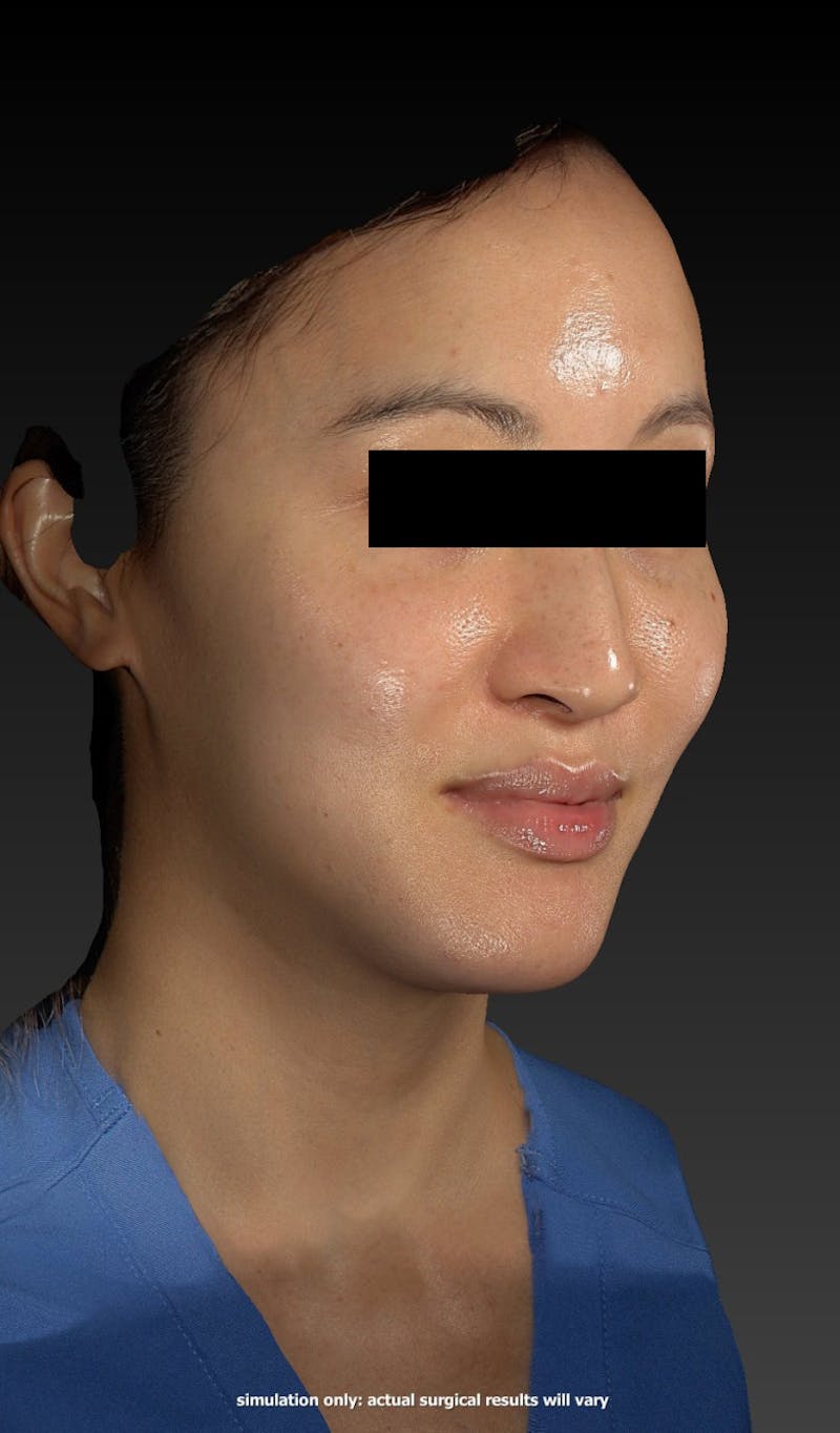 Botox Before & After Gallery - Patient 148991154 - Image 2