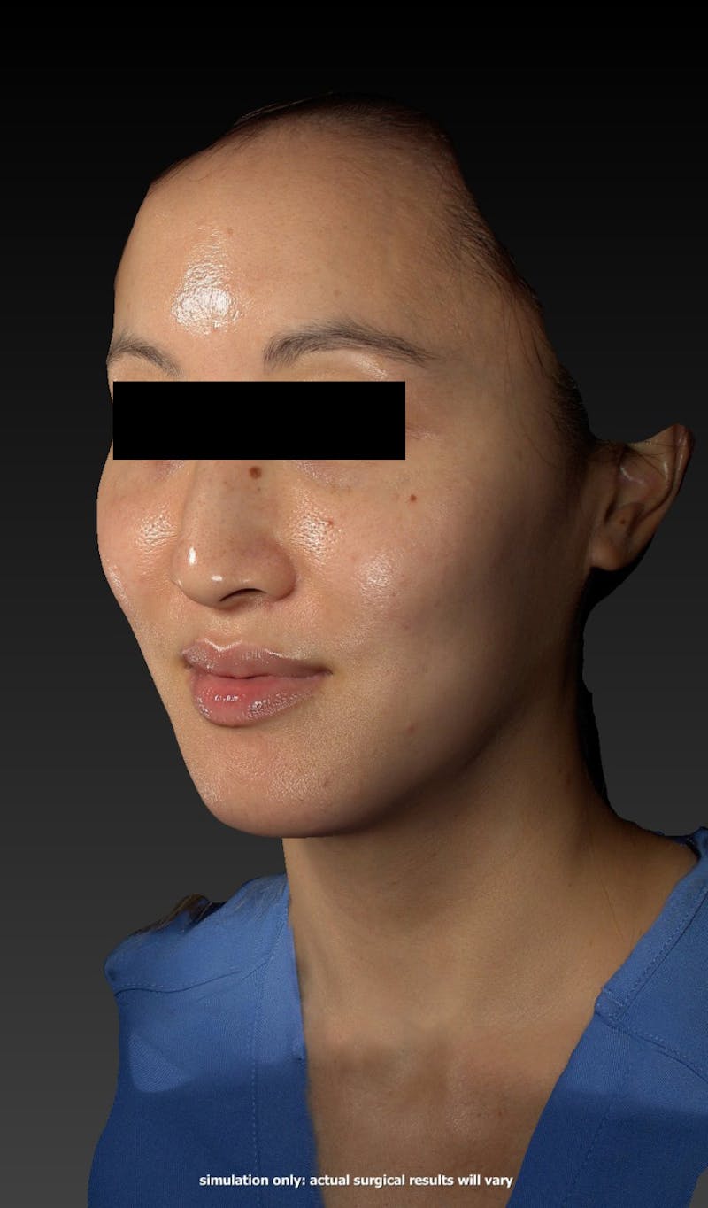Botox Before & After Gallery - Patient 148991154 - Image 6
