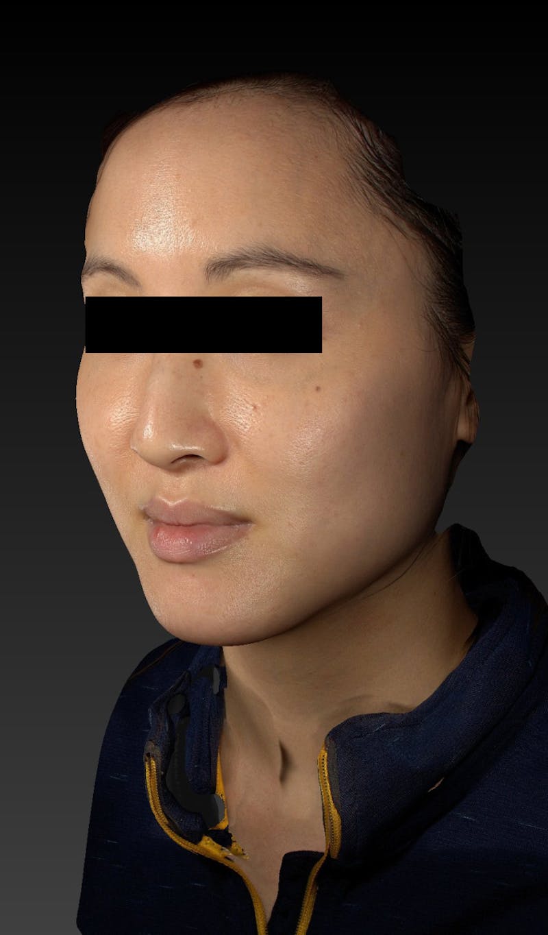 Dermal Fillers Before & After Gallery - Patient 148991158 - Image 5