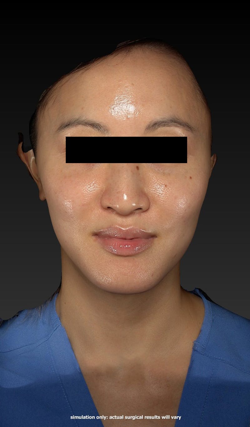 Dermal Fillers Before & After Gallery - Patient 148991158 - Image 4