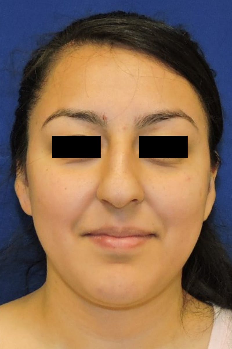 Rhinoplasty Before & After Gallery - Patient 148991127 - Image 5