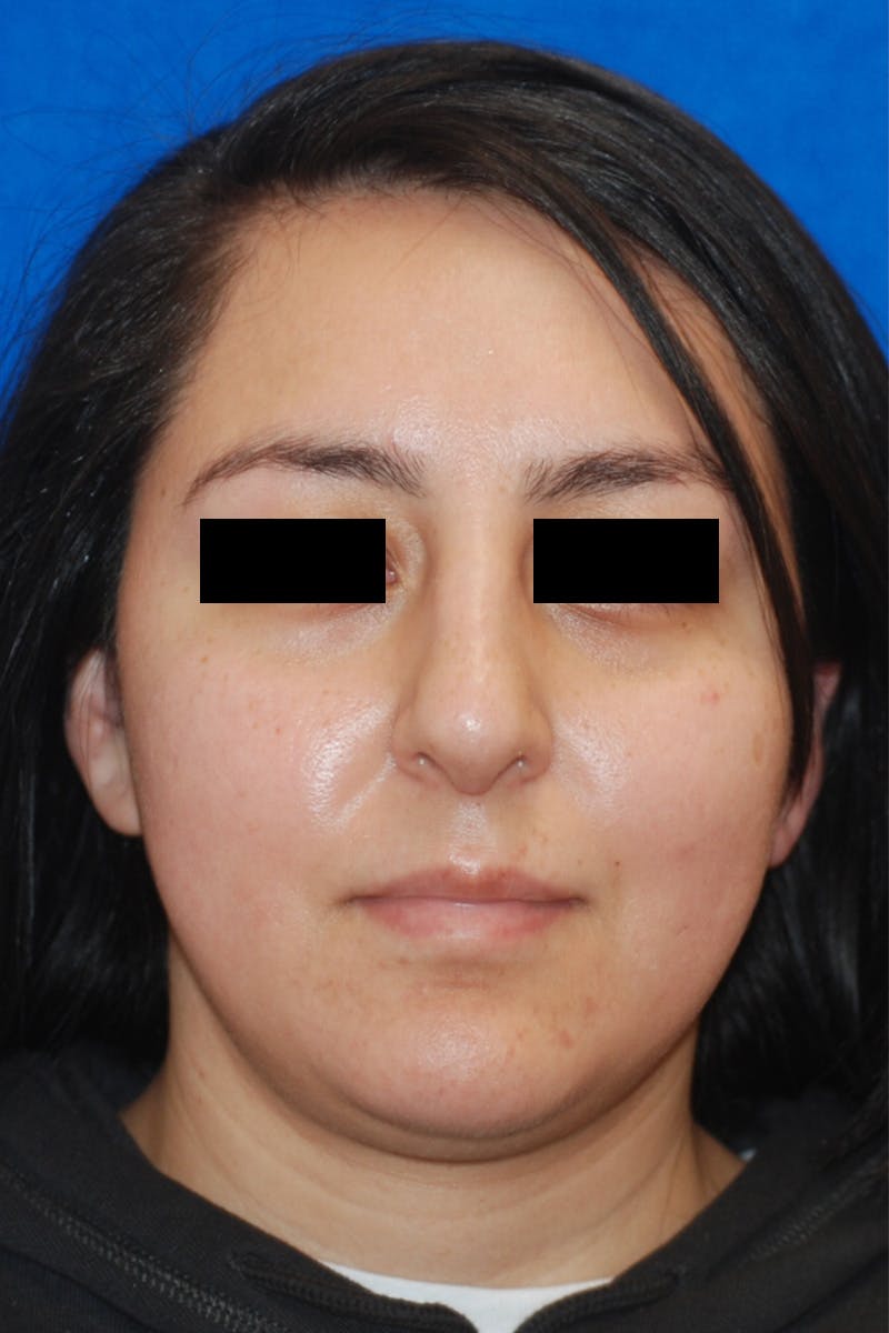 Rhinoplasty Before & After Gallery - Patient 148991127 - Image 6