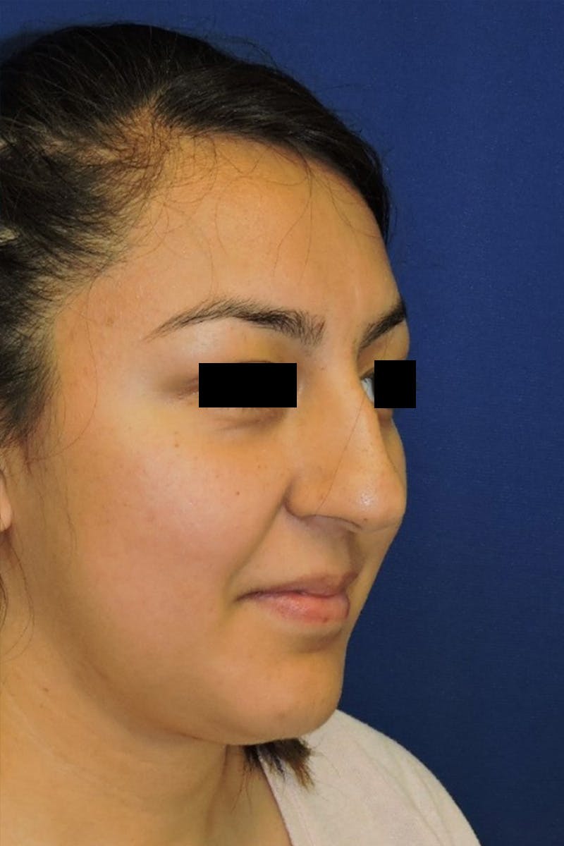Rhinoplasty Before & After Gallery - Patient 148991127 - Image 3