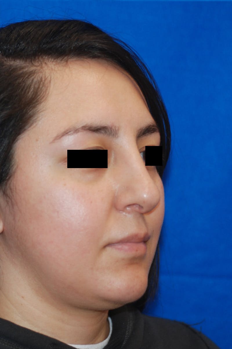Rhinoplasty Before & After Gallery - Patient 148991127 - Image 4