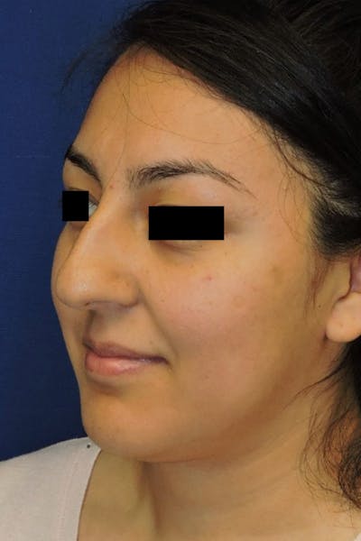 Rhinoplasty Before & After Gallery - Patient 148991127 - Image 1