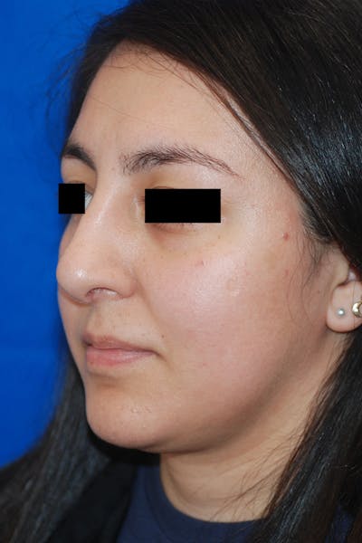 Rhinoplasty Before & After Gallery - Patient 148991127 - Image 2