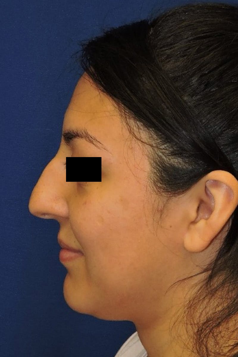 Rhinoplasty Before & After Gallery - Patient 148991127 - Image 7