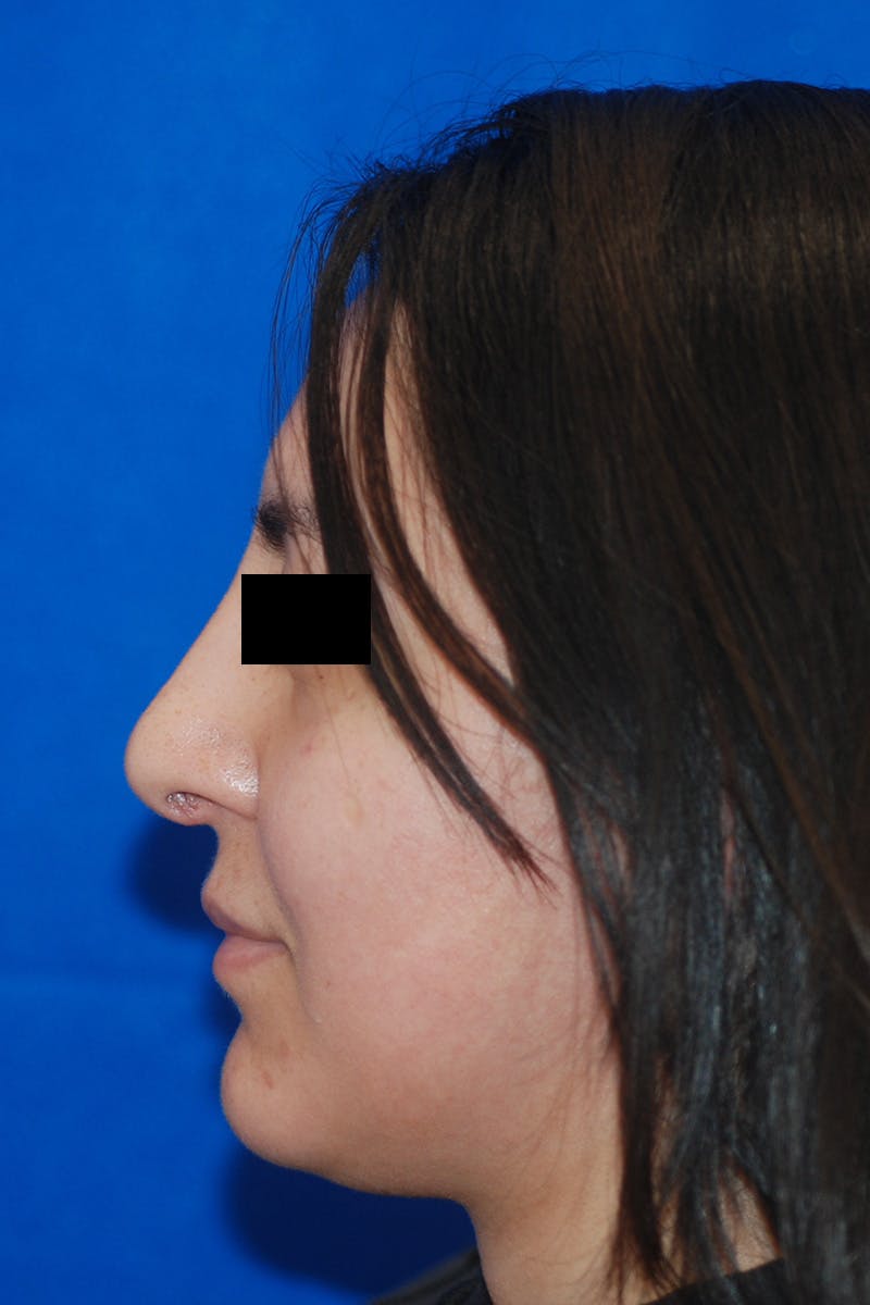 Rhinoplasty Before & After Gallery - Patient 148991127 - Image 8