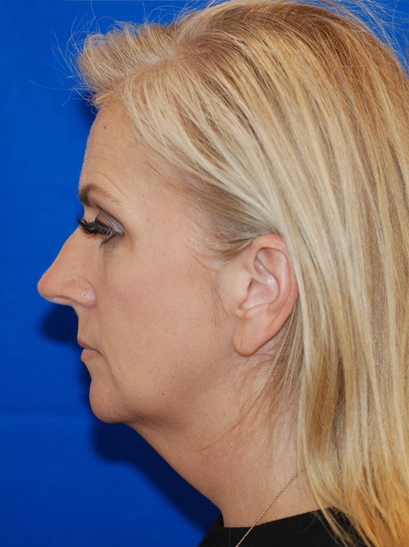 Facelift Before & After Gallery - Patient 145843 - Image 7