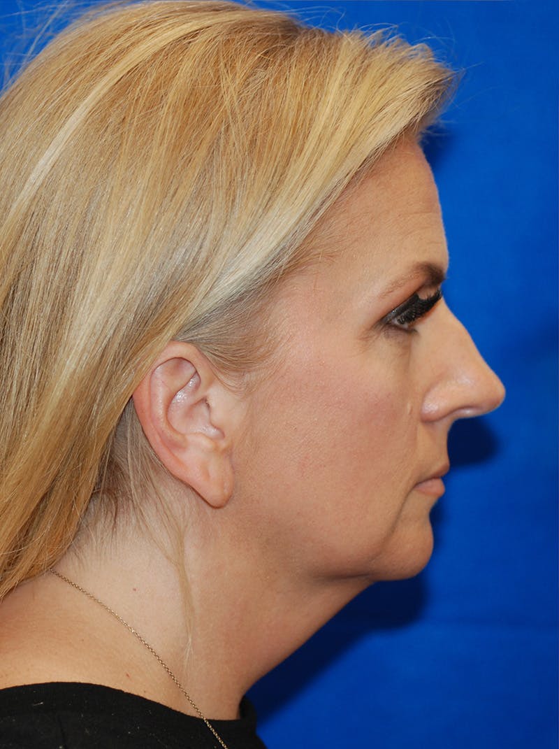 Facelift Before & After Gallery - Patient 145843 - Image 5